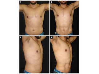 liposcultura addome prima e dopo
