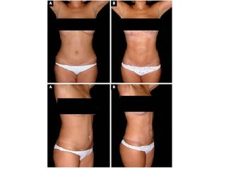 Liposcultura prima e dopo
