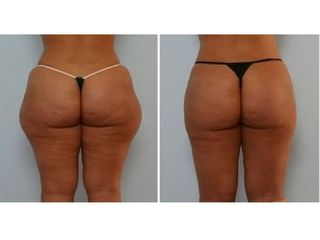 Liposuzione prima e dopo