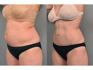 Addominoplastica - La Dermal Clinique