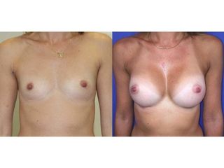 Mastoplastica additiva - La Dermal Clinique