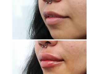 Filler labbra - La Dermal Clinique