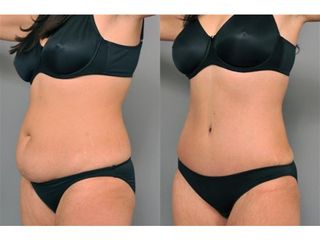 Liposuzione - La Dermal Clinique
