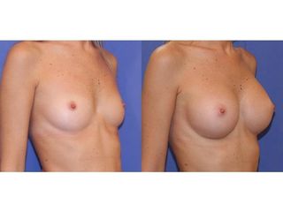 Mastoplastica additiva - La Dermal Clinique
