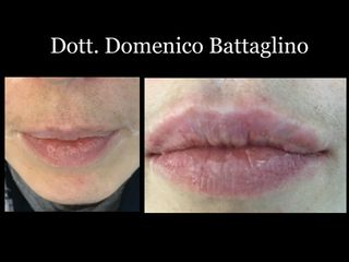 Filler labbra prima e dopo