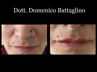 Filler labbra prima e dopo