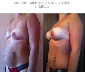 Addominoplastica e mastoplastica additiva