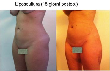 Liposcultura prima e dopo