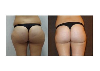 Liposcultura prima e dopo