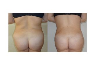Liposcultura