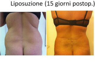 Liposuzione prima e dopo