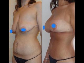 Liposcultura prima e dopo