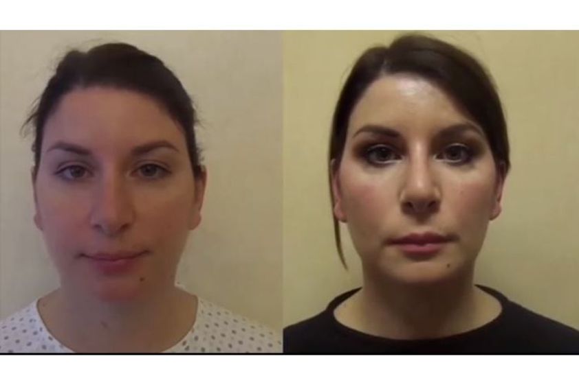 Bichectomia prima e dopo - 771823