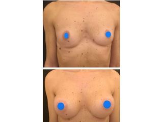 Mastoplastica additiva - Dr Ernesto Maria Buccheri