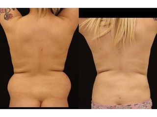 Liposuzione - Dr Ernesto Maria Buccheri