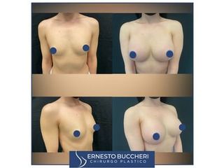 mastoplastica additiva - Dr Ernesto Maria Buccheri Medicinaplastica