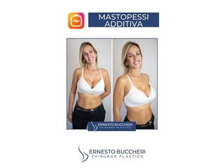 mastoplastica additiva - Dr Ernesto Maria Buccheri Medicinaplastica