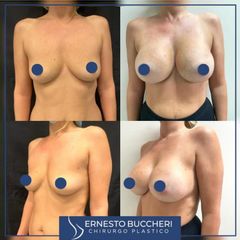 Mastoplastica additiva - Dr Ernesto Maria Buccheri Medicinaplastica