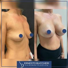 Mastoplastica additiva - Dr Ernesto Maria Buccheri Medicinaplastica
