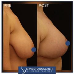 Mastoplastica riduttiva - Dr Ernesto Maria Buccheri Medicinaplastica