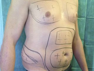 Ginecomastia e Lipo Addome e fianchi - Pre Operatorio