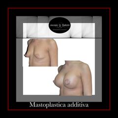 Mastoplastica additiva - Dott. Jacopo Gallotti