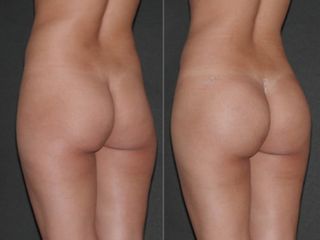 Glutei prima e dopo