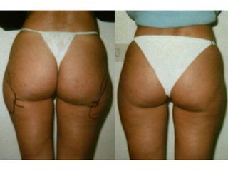 Liposcultura prima e dopo