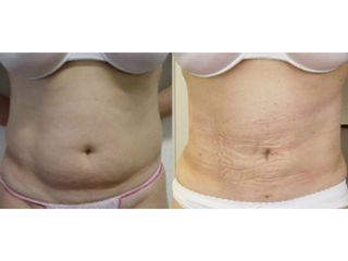 Liposcultura pancia prima e dopo