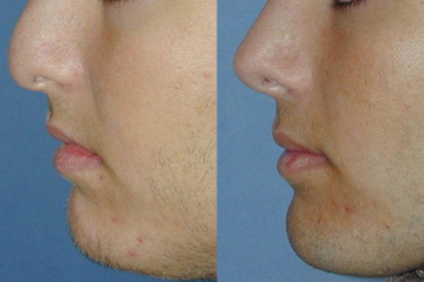 Mentoplastica prima e dopo - 751853