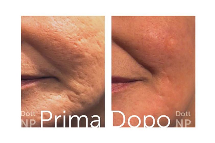 Rughe prima e dopo - 824167