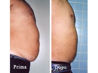 Addominoplastica prima e dopo