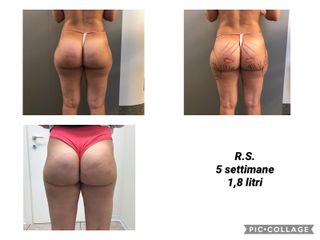 Liposuzione - Dott. Alfonso Milone