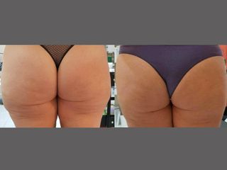 liposuzione prima dopo