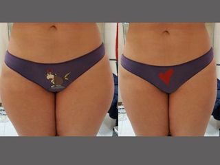 liposuzione prima dopo