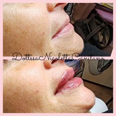 Filler labbra - Dott.ssa Nicoletta Canitano