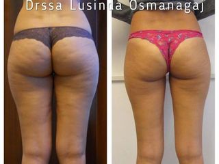 Cellulite prima e dopo