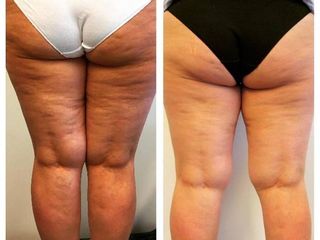 Cellulite prima e dopo