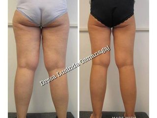 Dieta e carbossiterapia prima dopo