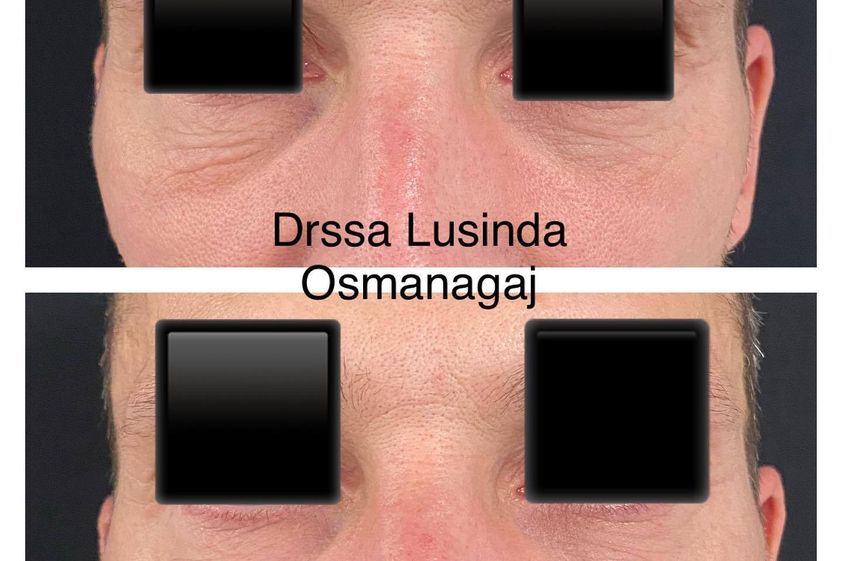 Eliminare occhiaie prima e dopo - 821560