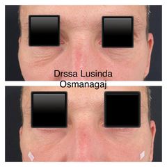 Eliminare occhiaie - Dott.ssa Lusinda Osmanagaj