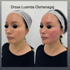 Acido ialuronico - Dott.ssa Lusinda Osmanagaj