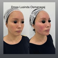 Acido ialuronico - Dott.ssa Lusinda Osmanagaj