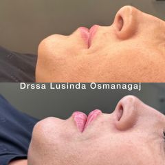 Filler labbra - Dott.ssa Lusinda Osmanagaj