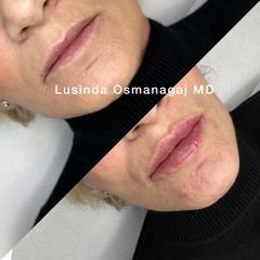 Filler labbra - Dott.ssa Lusinda Osmanagaj