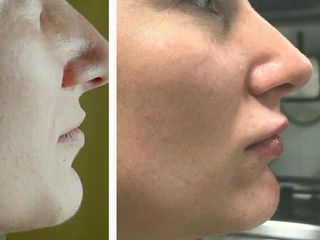 Labbra prima e dopo