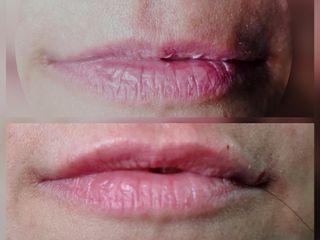 Filler labiale prima e dopo