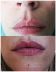 Ritocco labbra prima e dopo