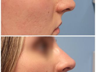 Rinofiller prima e dopo - 877488