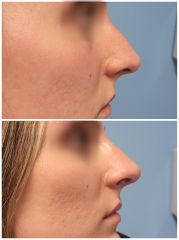 Dott. Marco Di Clemente Rinofiller